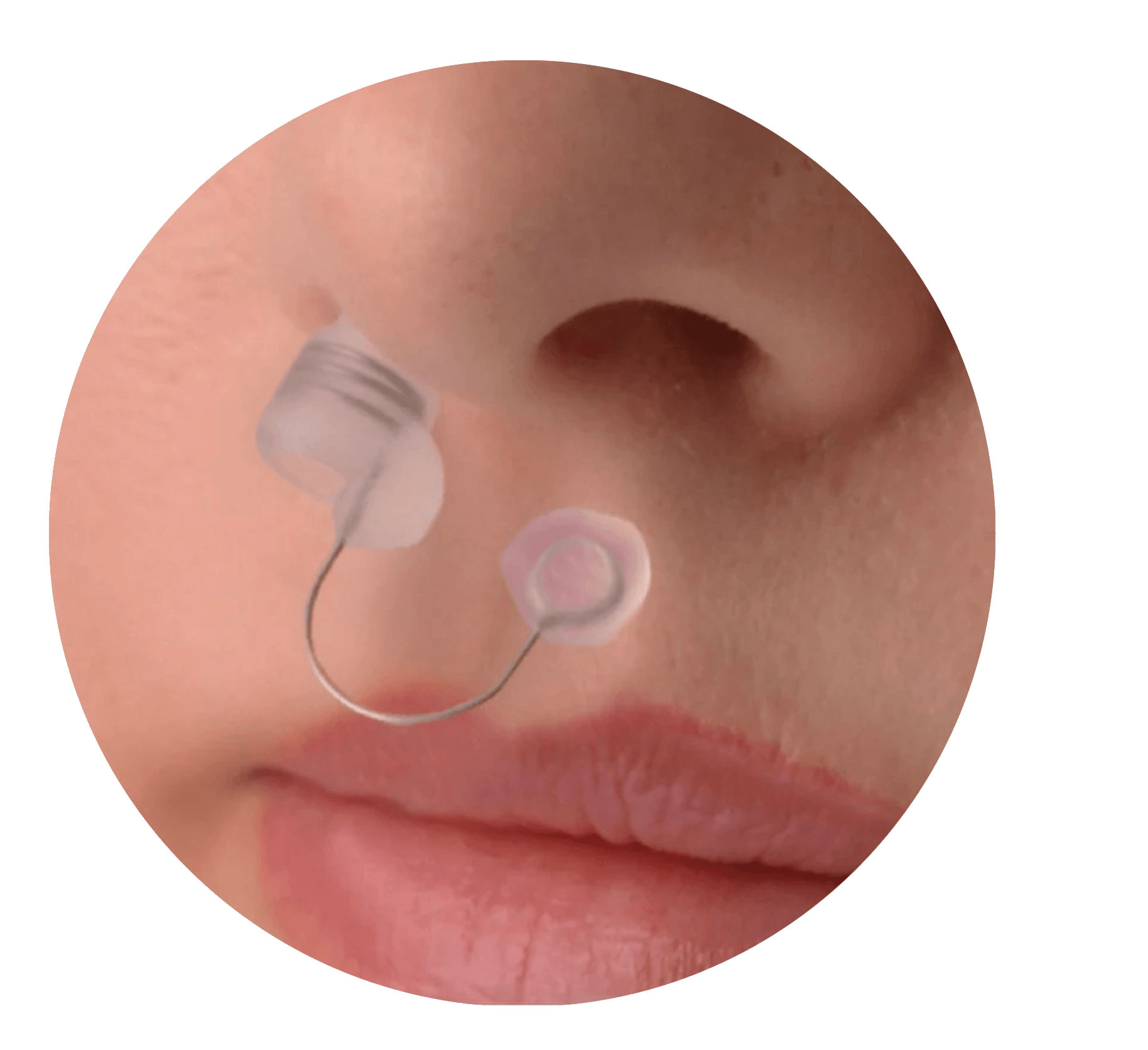 Discretion of the Back2Sleep stent once inserted