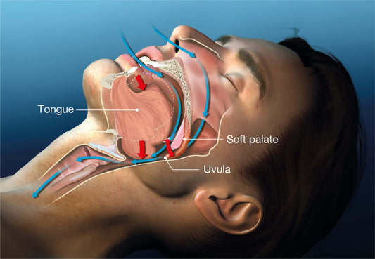 How Sleep Apnea is Treated: Types, Symptoms, and Solutions - Back2Sleep