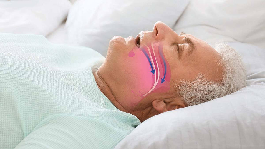 Obstructive Sleep Apnea (OSA): Causes, Symptoms, and Treatment