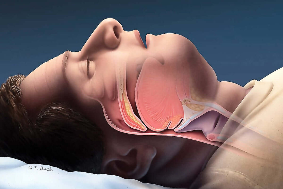 What Are the Causes of Sleep Apnea?