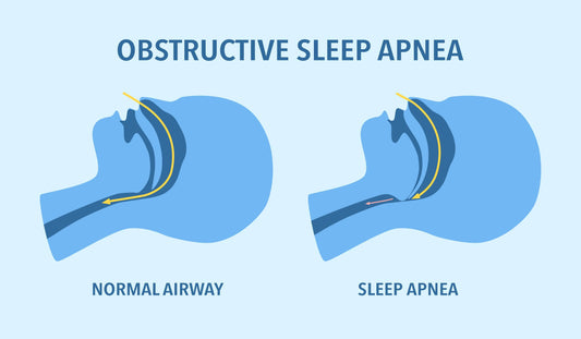 Anti Snoring Device Reviews