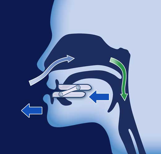 Anti-snoring gutter: which one to choose? Full review! - Back2Sleep