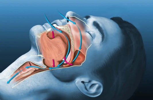 The Link Between Snoring and Sleep Apnea: What You Need to Know - Back2Sleep