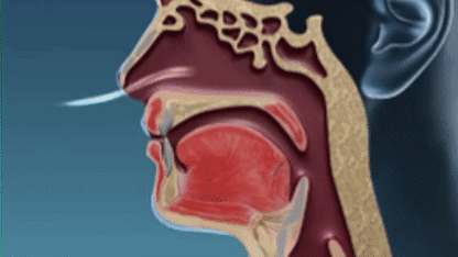 SnoreKit anti-snoring Back2Sleep
