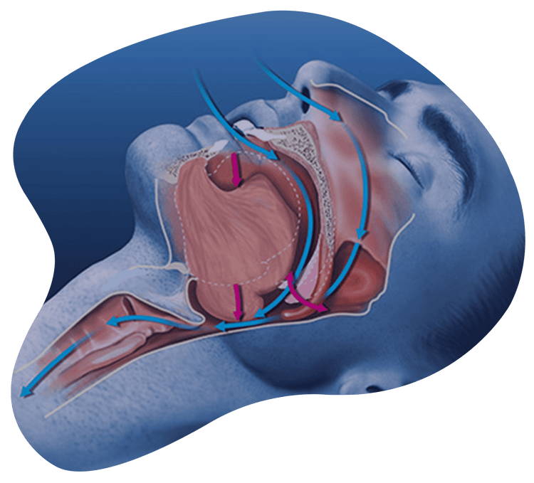 Sleep apnea mechanism - airway obstruction diagram