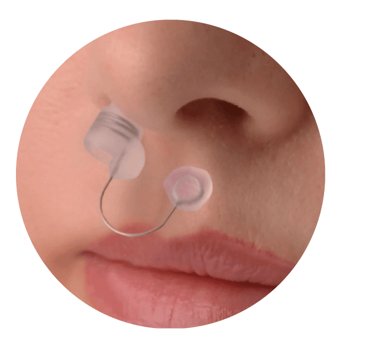 Discretion of the Back2Sleep stent once inserted